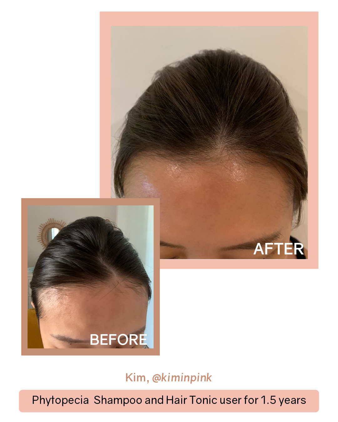 Phytopecia+ Complete Scalp Care Set